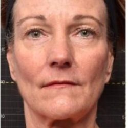 Sofwave Before & After Patient #1600